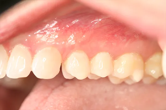 Alloderm-2-After