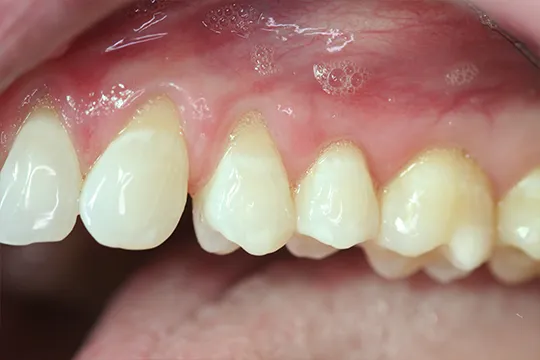 Alloderm-2-Before