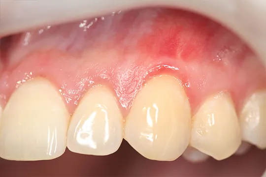 Connective-Tissue-Graft-1_after