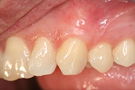Connective-Tissue-Graft-3_after