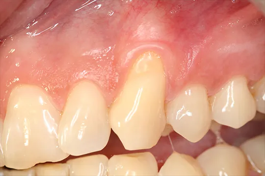 Connective-Tissue-graft-3_before