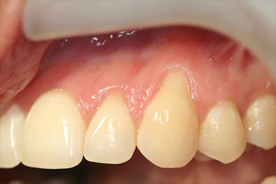 Connective-tissue-graft-1_before