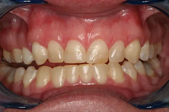 Cosmetic-Crown-Lengthening-1_after