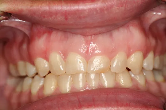 Cosmetic-Crown-Lengthening-1_before
