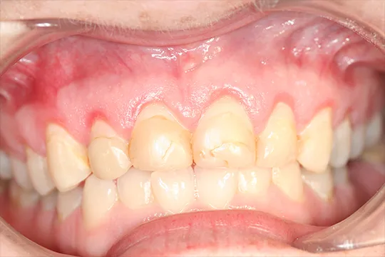 Cosmetic-Crown-Lengthening-2_after