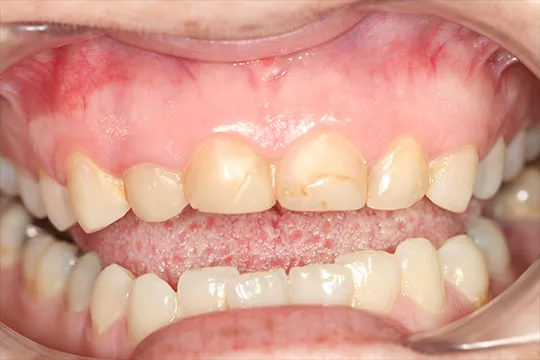 Cosmetic-Crown-Lengthening-2_before