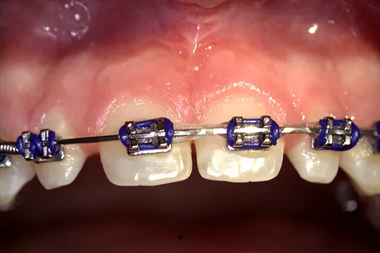 Frenectomy-1_after