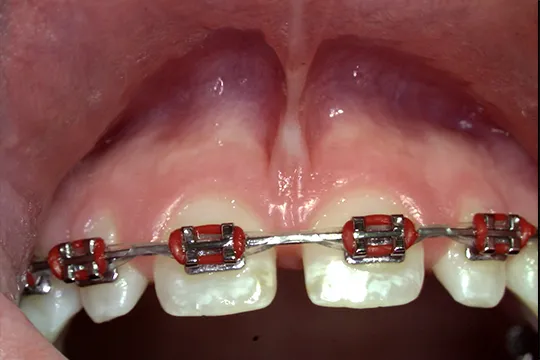 Frenectomy-1_before
