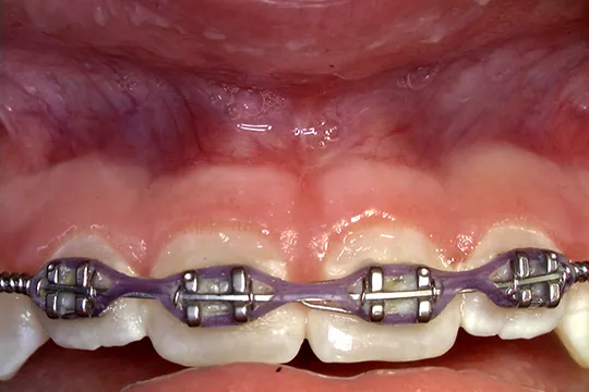 Frenectomy-2_after