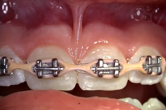 Frenectomy-2_before