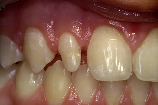 Functional-Crown-Lengthening-1_after