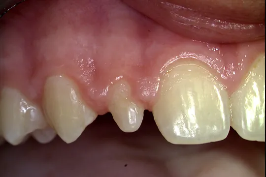 Functional-Crown-Lengthening-1_before