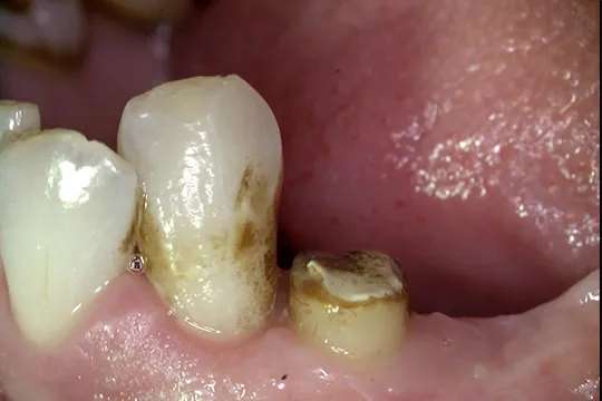 Functional-Crown-Lengthening-2_after