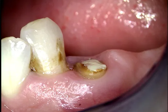 Functional-Crown-Lengthening-2_before