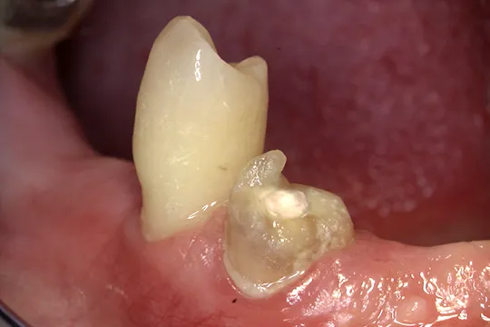 Functional-Crown-Lengthening-3_after