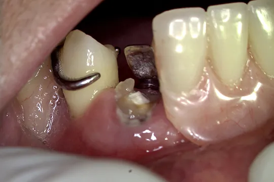 Functional-Crown-Lengthening-3_before