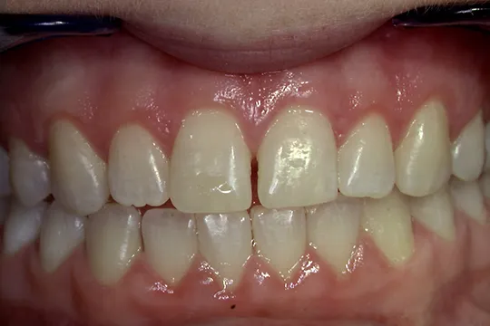 Gingivectomy-1_after