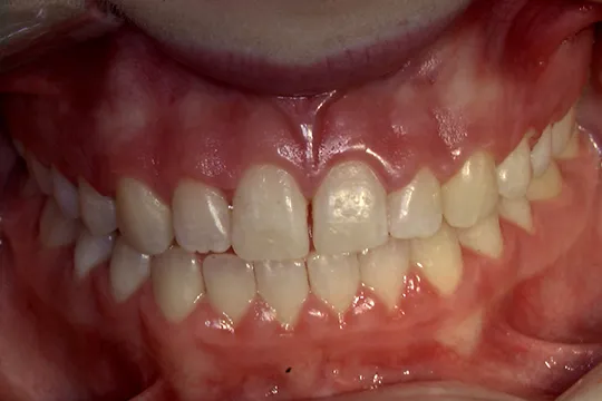 Gingivectomy-1_before