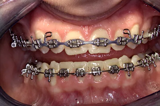 Gingivectomy-2_after
