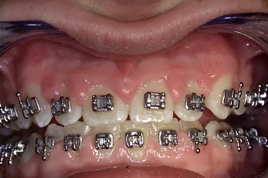 Gingivectomy-2_before
