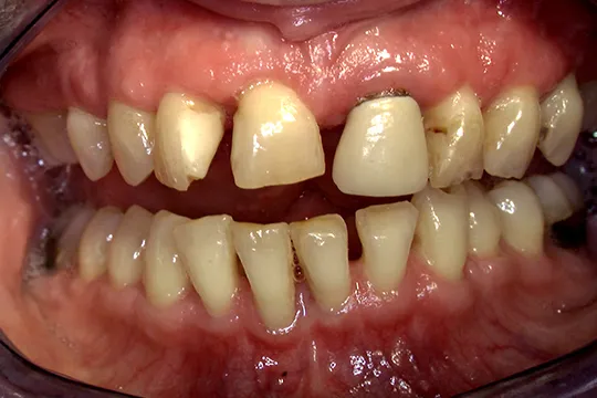 Periodontal-Surgery_after