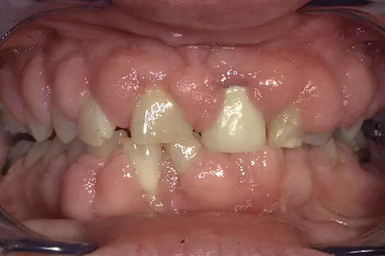 Periodontal-Surgery