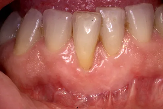 Soft-Tissue-Graft-2_after