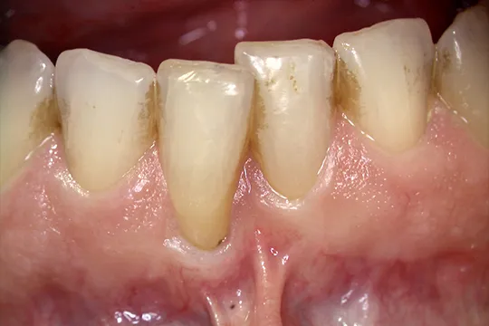 Soft-Tissue-Graft-2_before