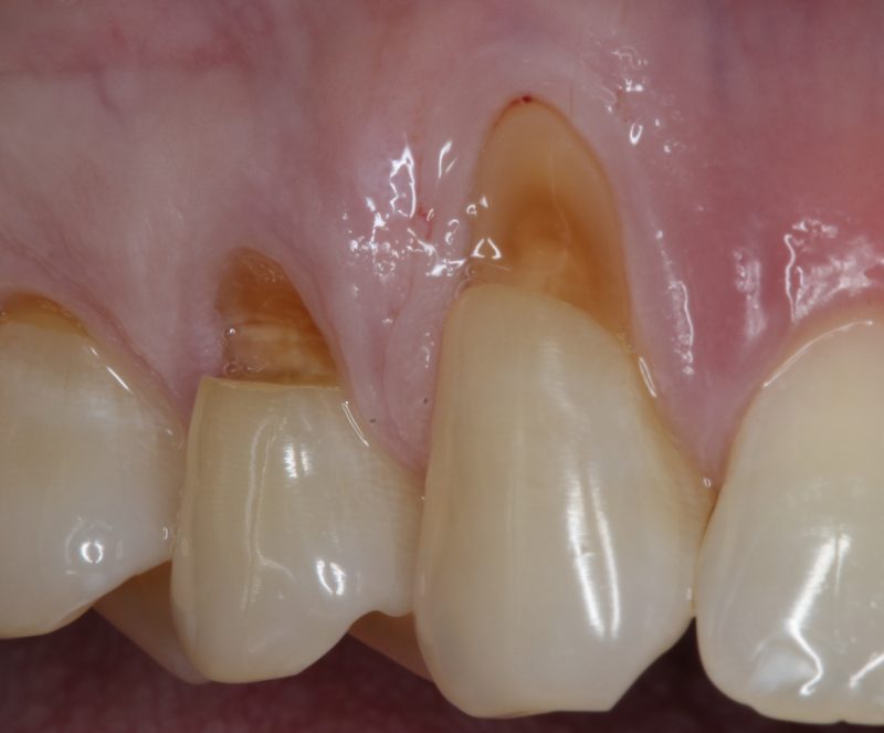 Before Connective Tissue Graft