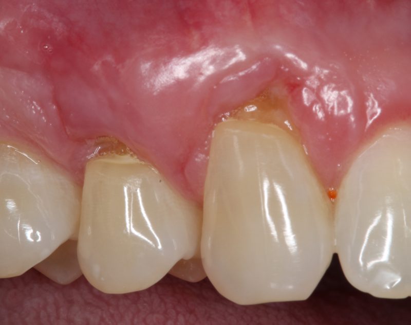 After Connective Tissue Graft