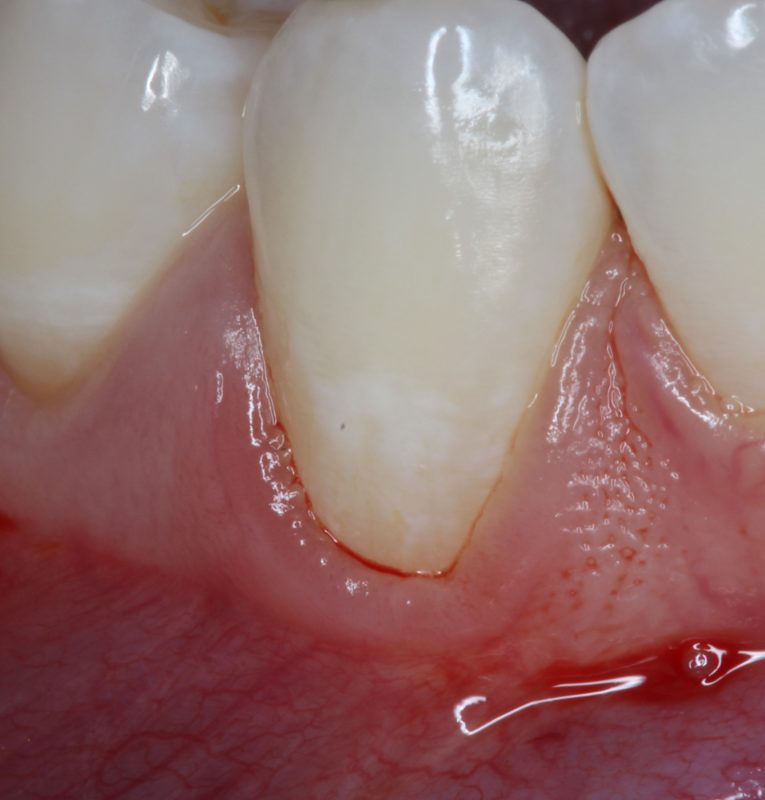 Before Connective Tissue Graft