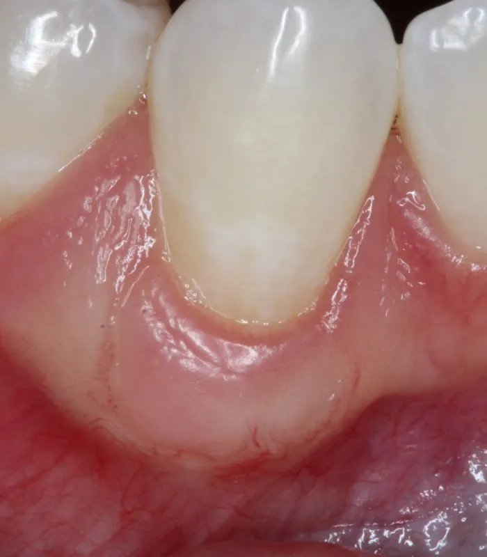 After Connective Tissue Graft