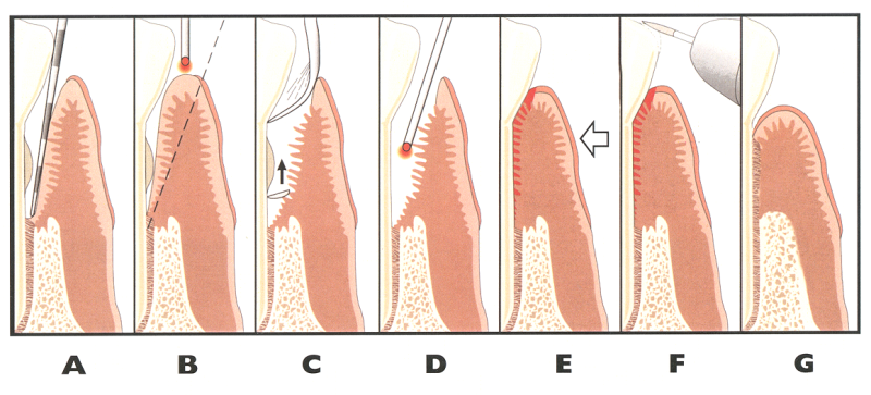 Laser Periodontal Therapy