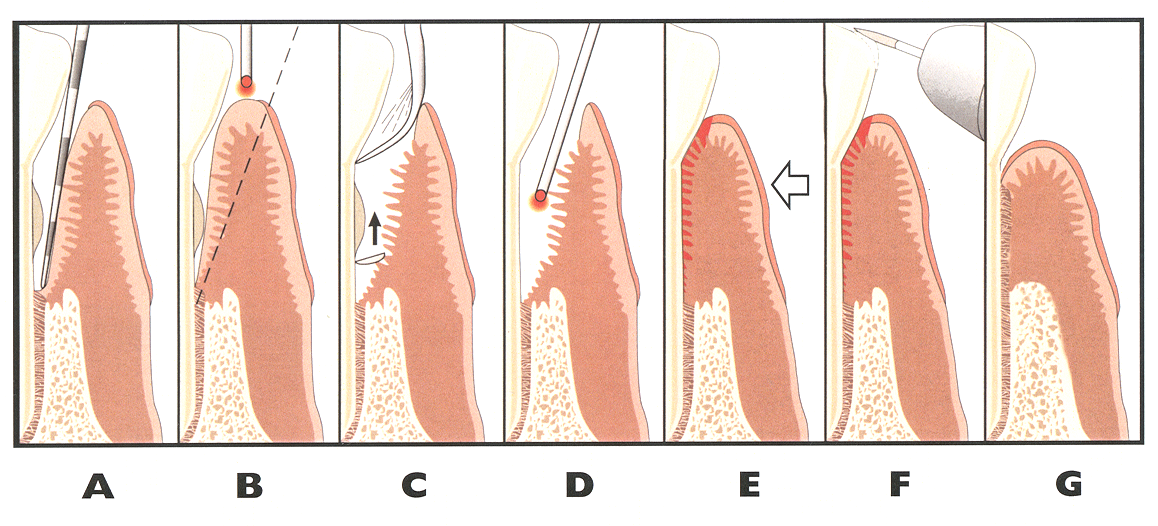 Laser Periodontal Therapy