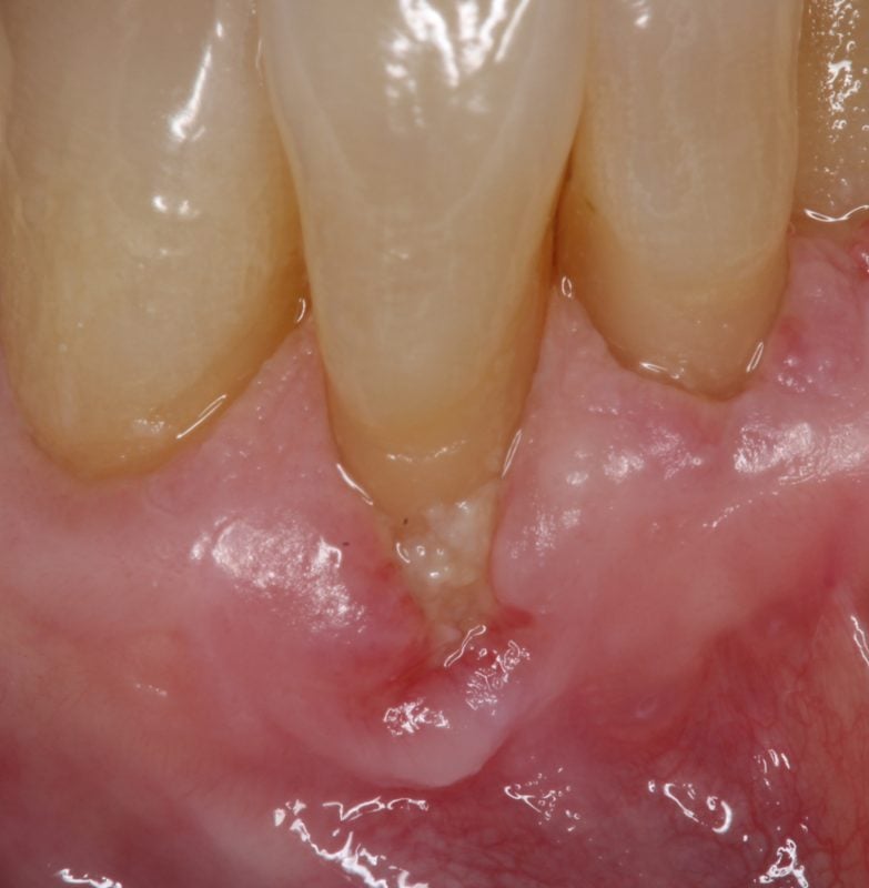 Before Soft Tissue Graft