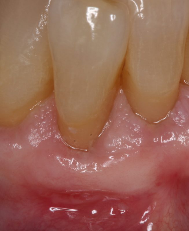 After Soft Tissue Graft