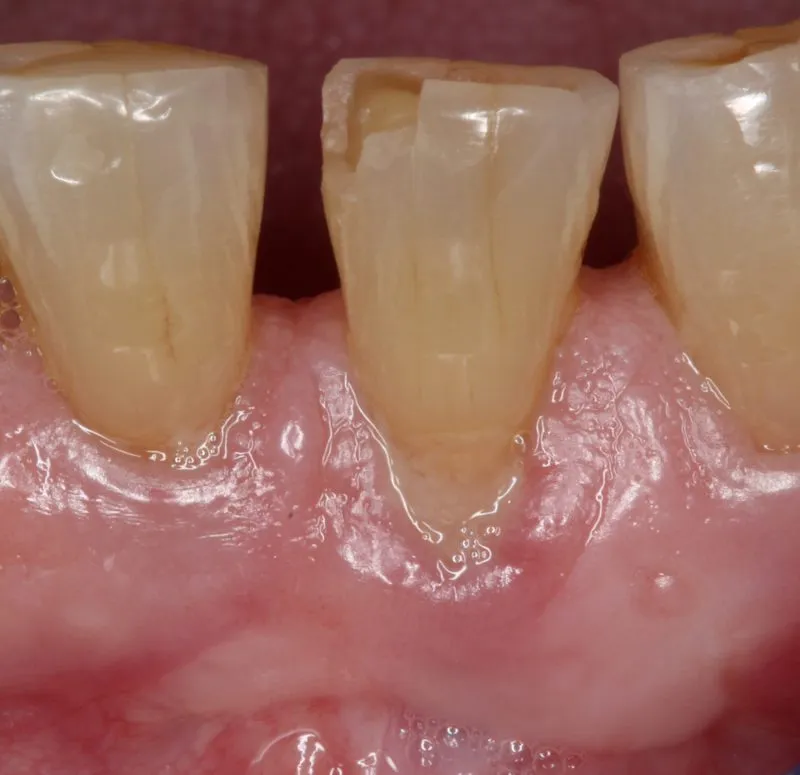 After Soft Tissue Graft