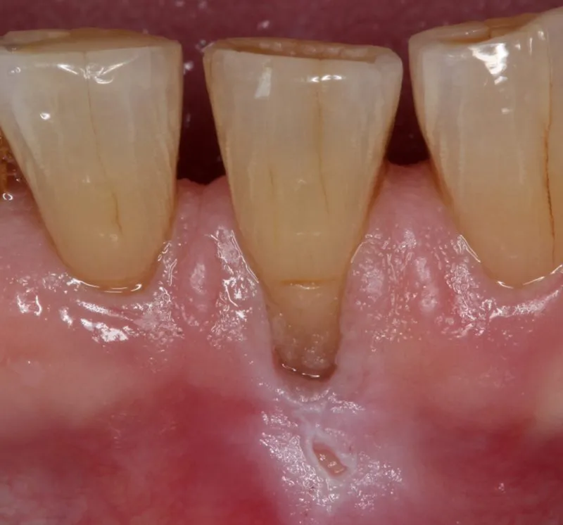 Before Soft Tissue Graft